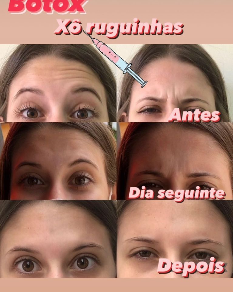 Prevenção de Rugas- Toxina Botulínica - Botox.